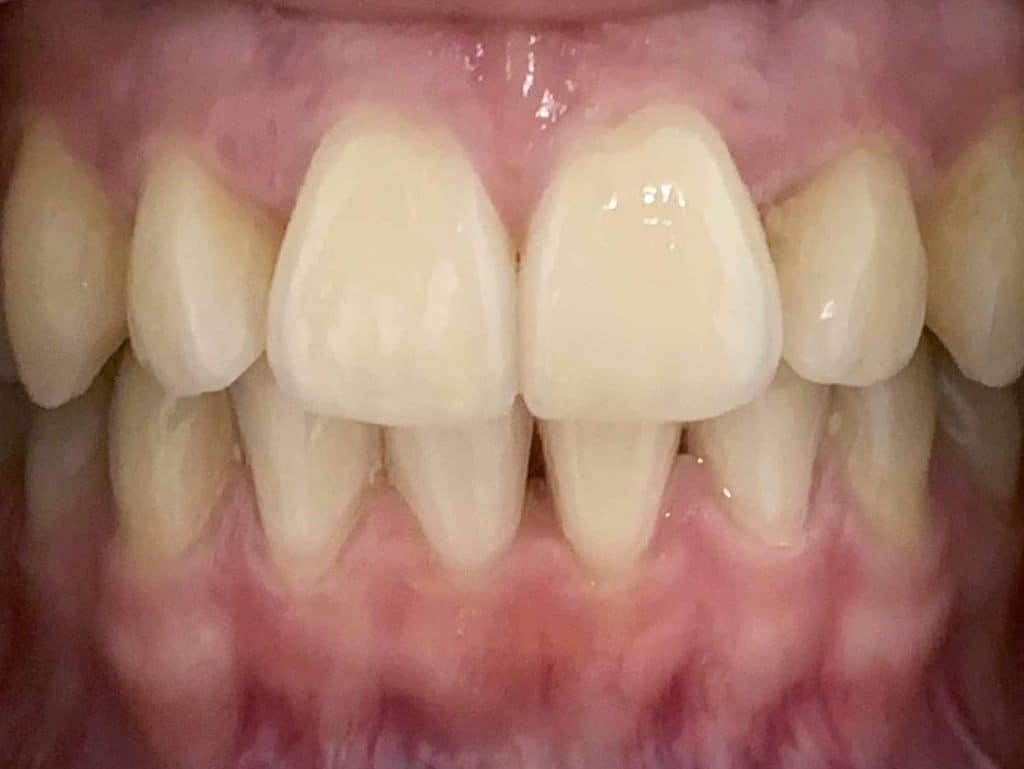 Invisalign After