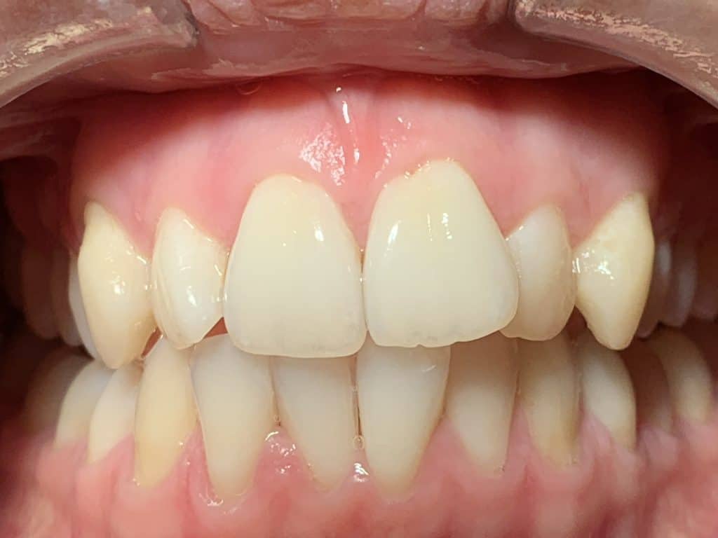 Invisalign Before