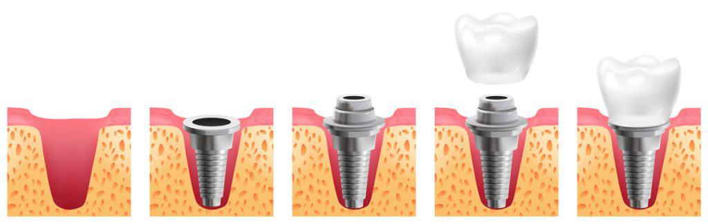 Dental Implant Stages