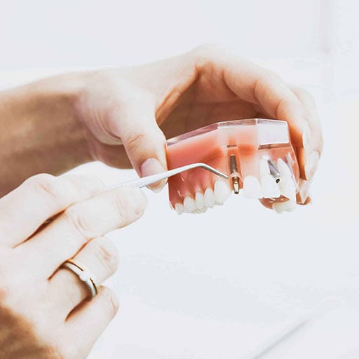 Dental Implants Free Consultation Perth