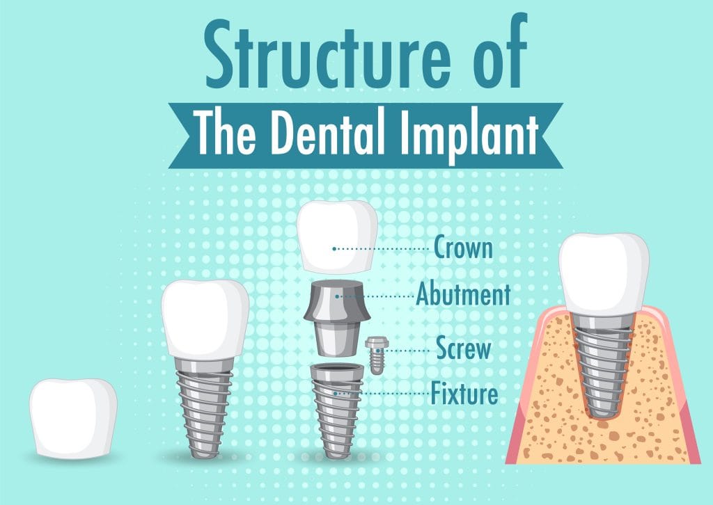 Dental Implant Structure