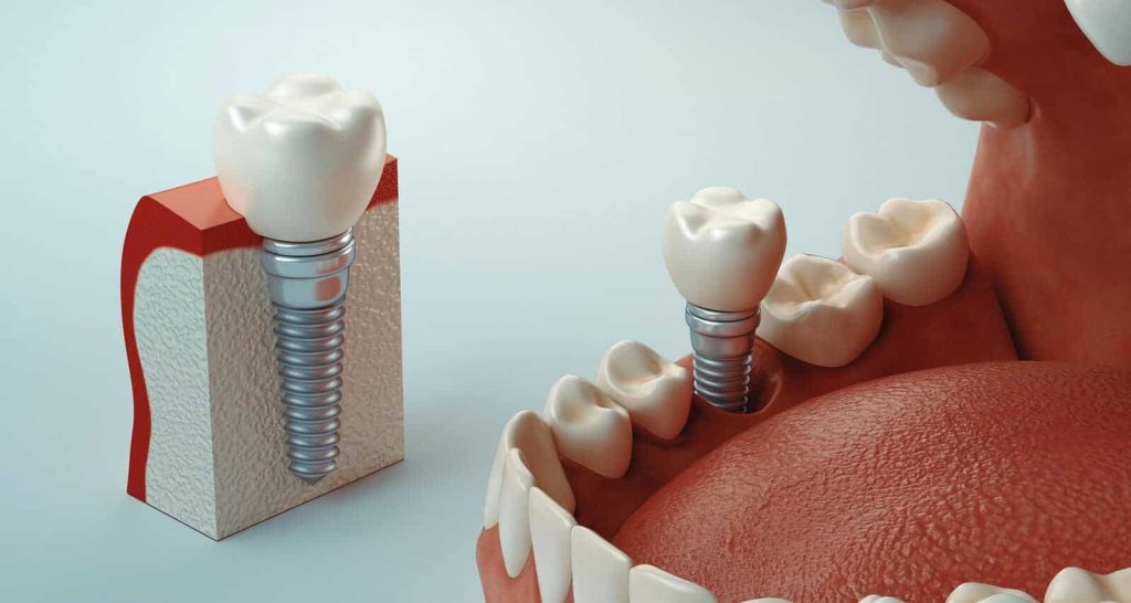 Dental Implants Explained